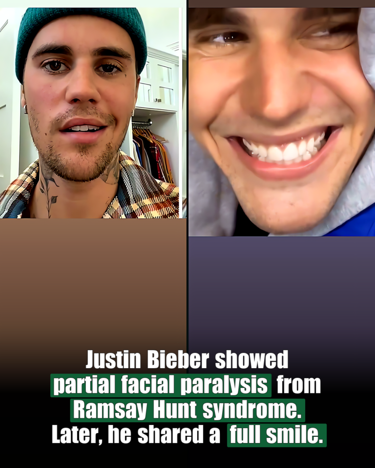 Justin Bieber facial recovery from Ramsay Hunt syndrome